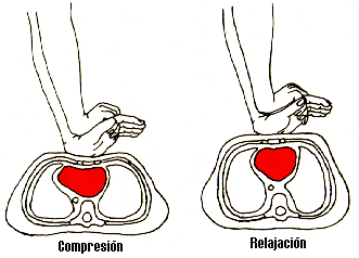 Compresión Cardíaca Externa